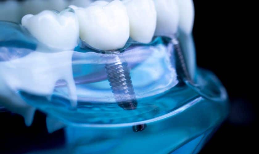 Dental Implant