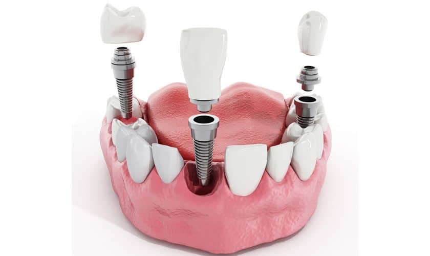 Dental Implants