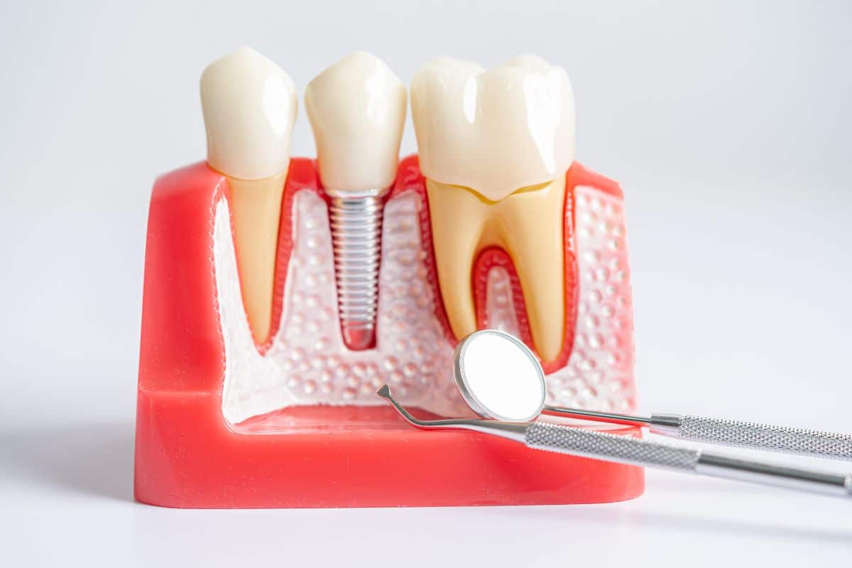 Root Canal Therapy in Hot Springs