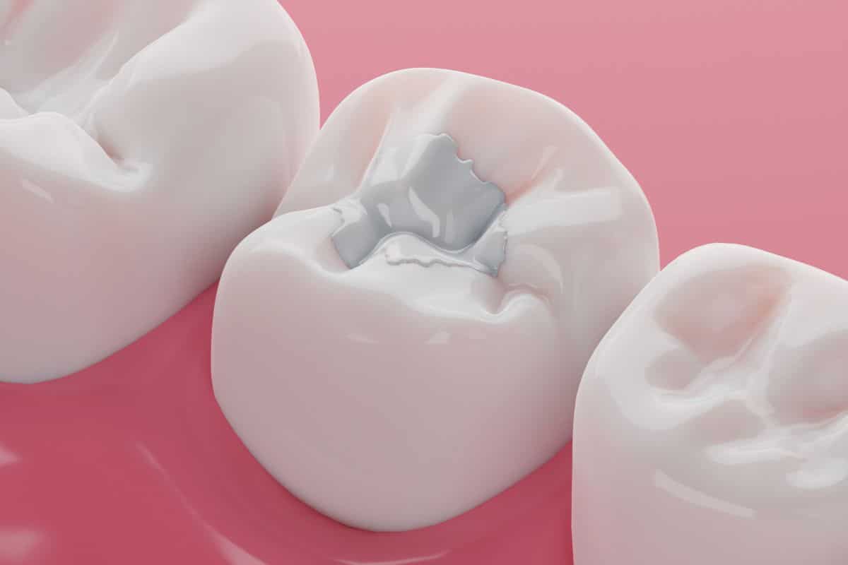 Dental fillings