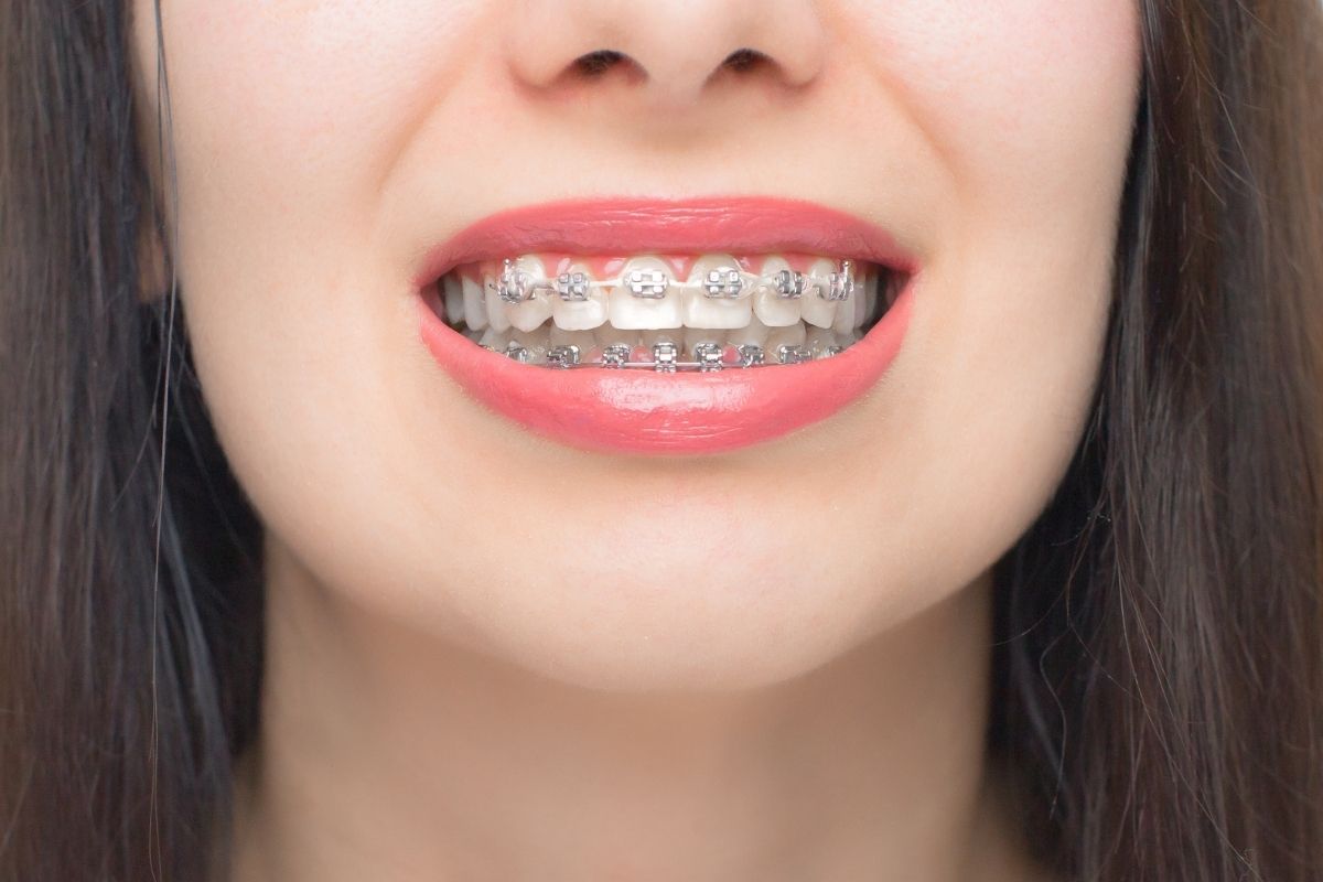 Orthodontic Treatment
