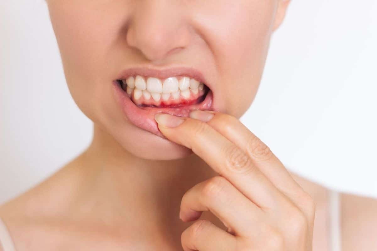Woman pointing to inflamed gum tissue showing signs of periodontal disease and bleeding gums.