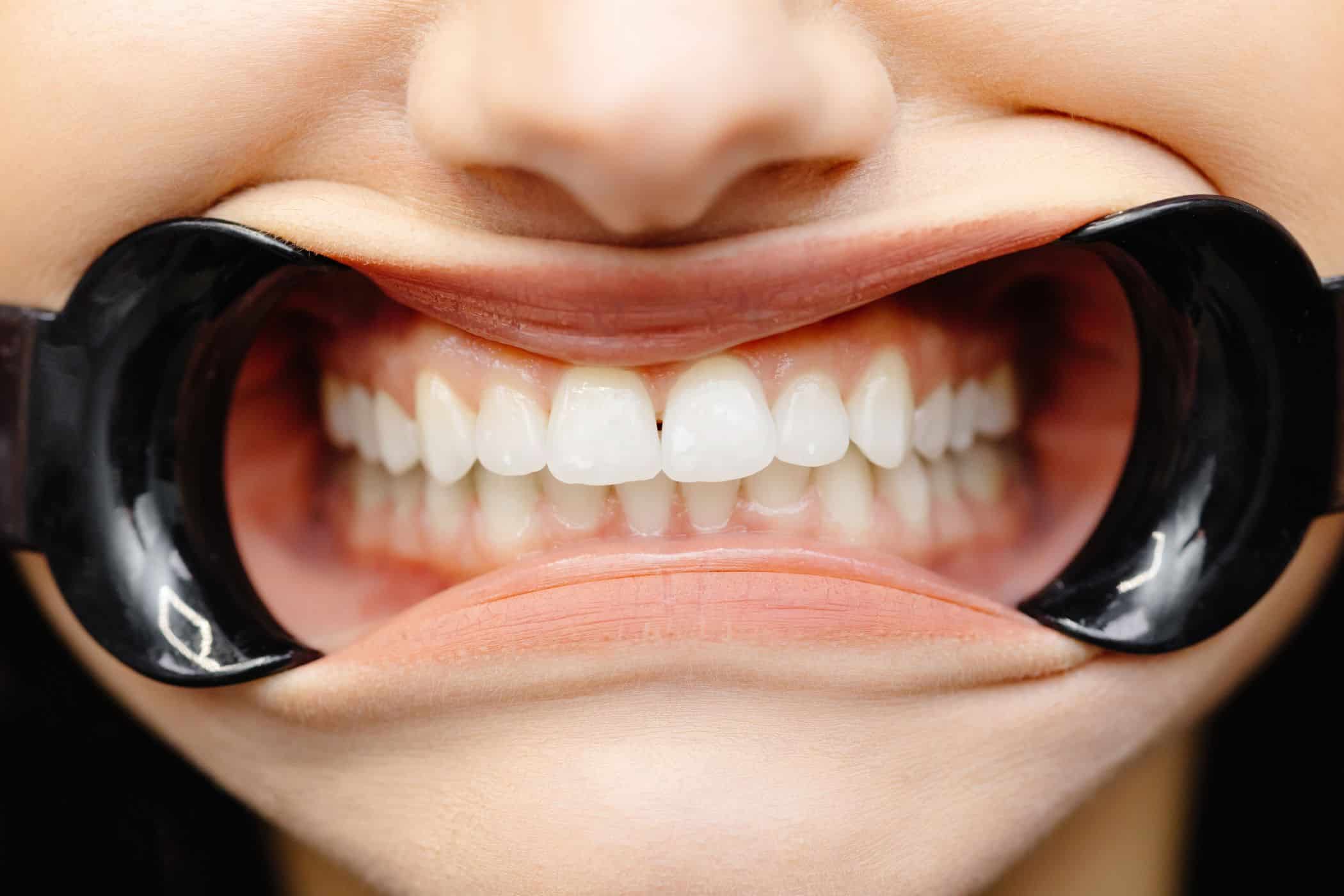 teeth whitening science